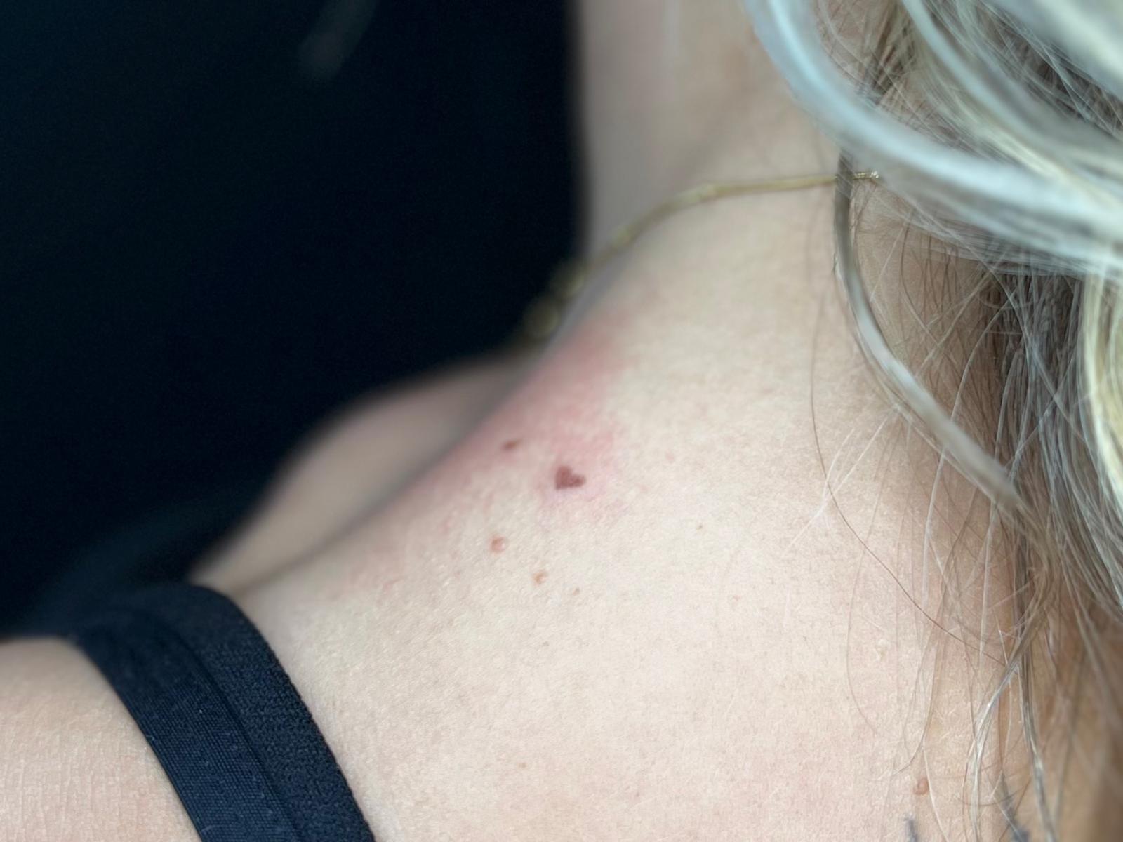 Freckle Hearts behandeling