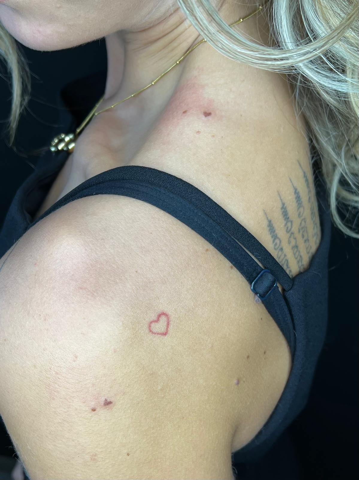 Freckle hearts nazorg