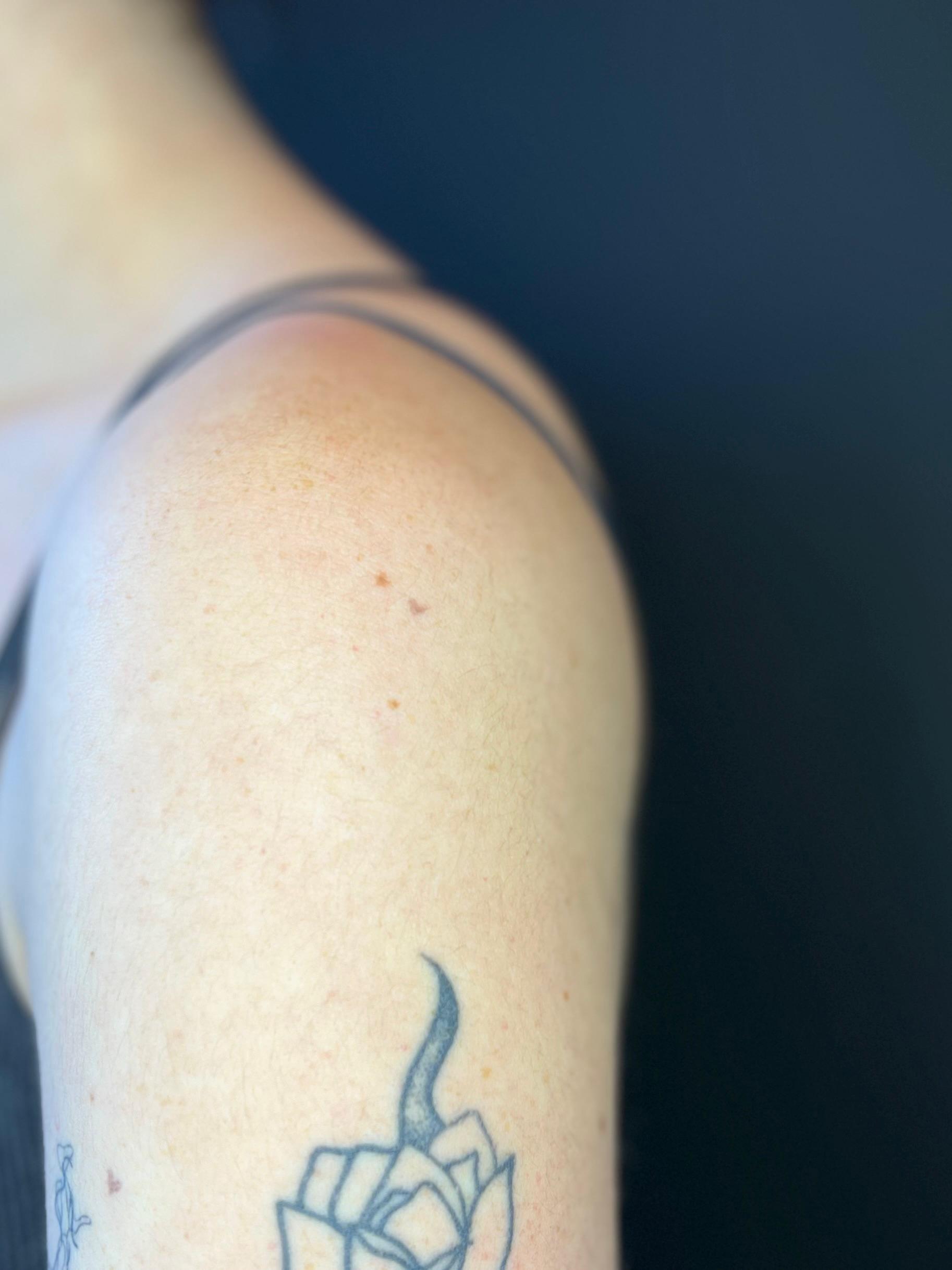 Freckle hearts, genezen