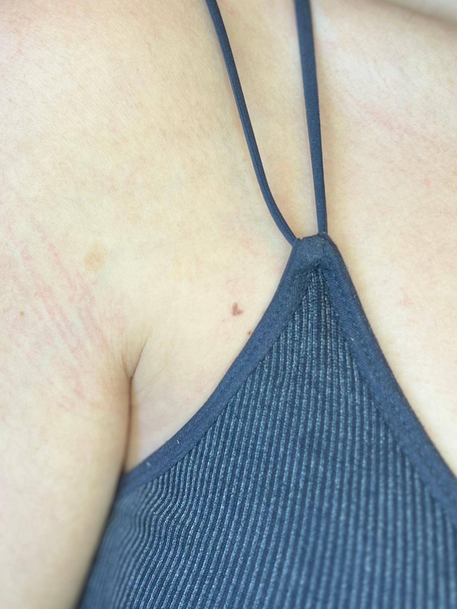 Freckle hearts, genezen