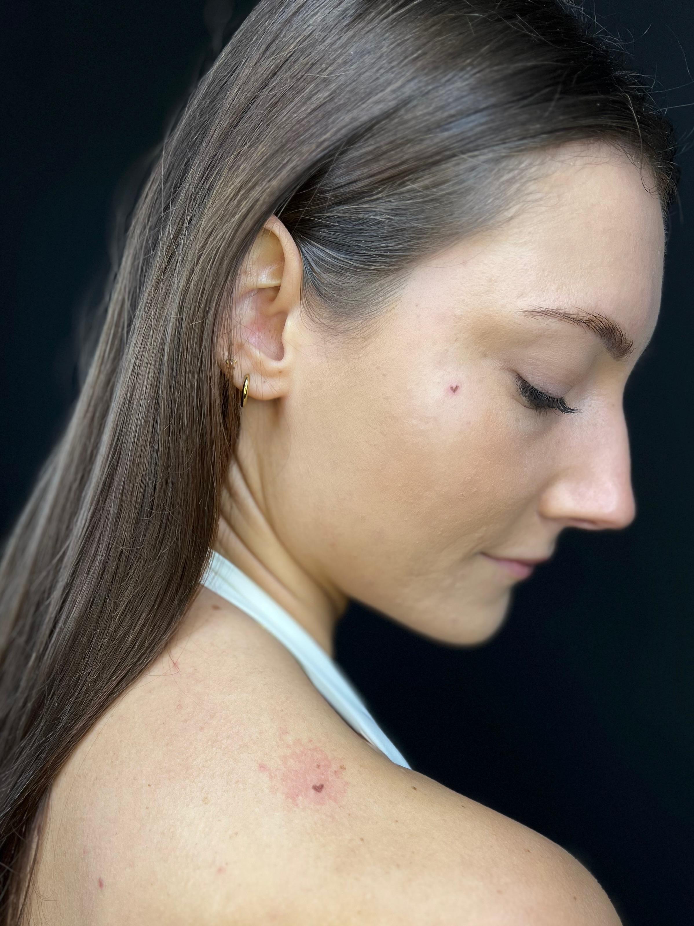 Freckle hearts, direct na de behandeling