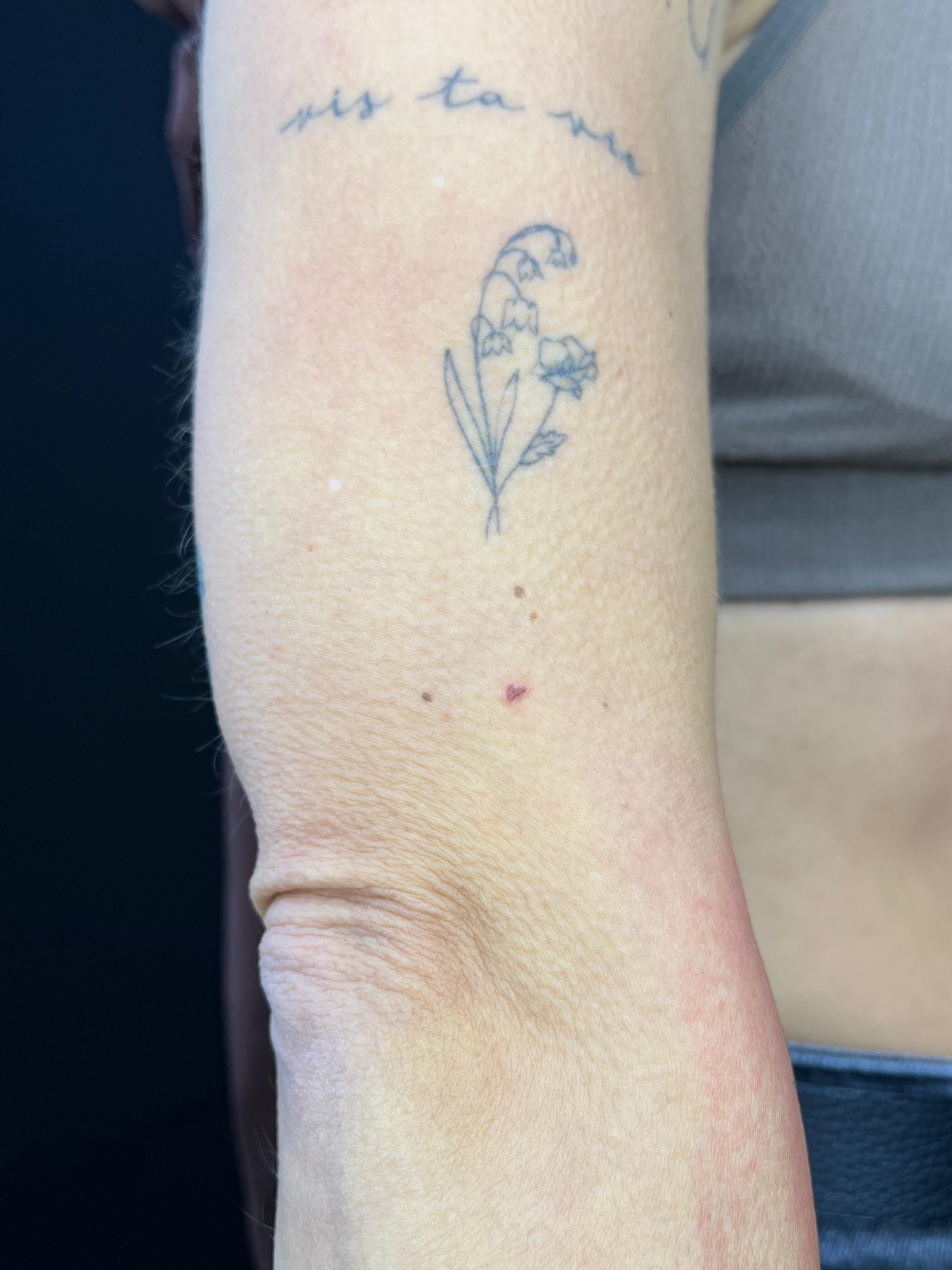 Freckle hearts, direct na de behandeling