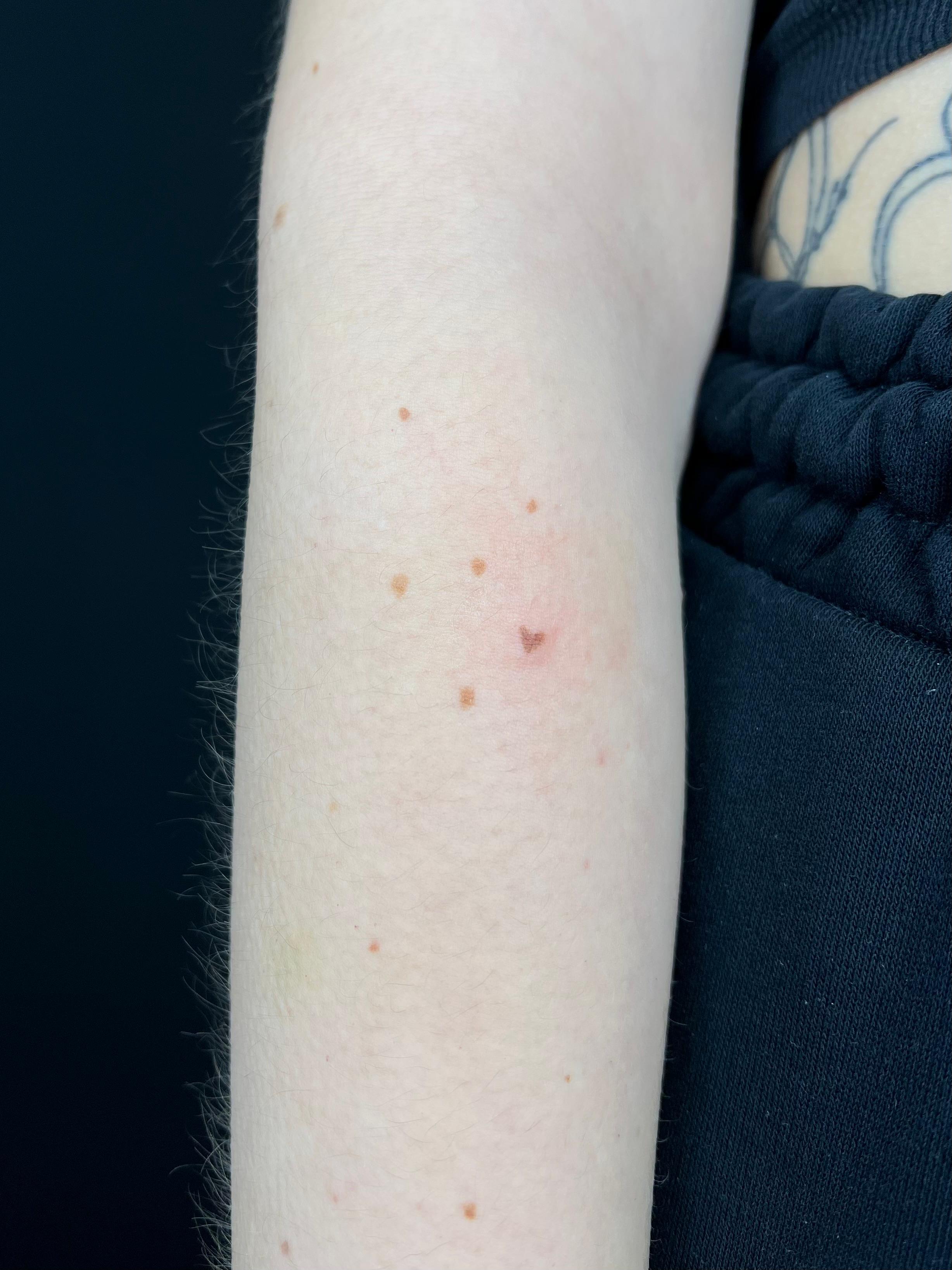 Freckle hearts, direct na de behandeling