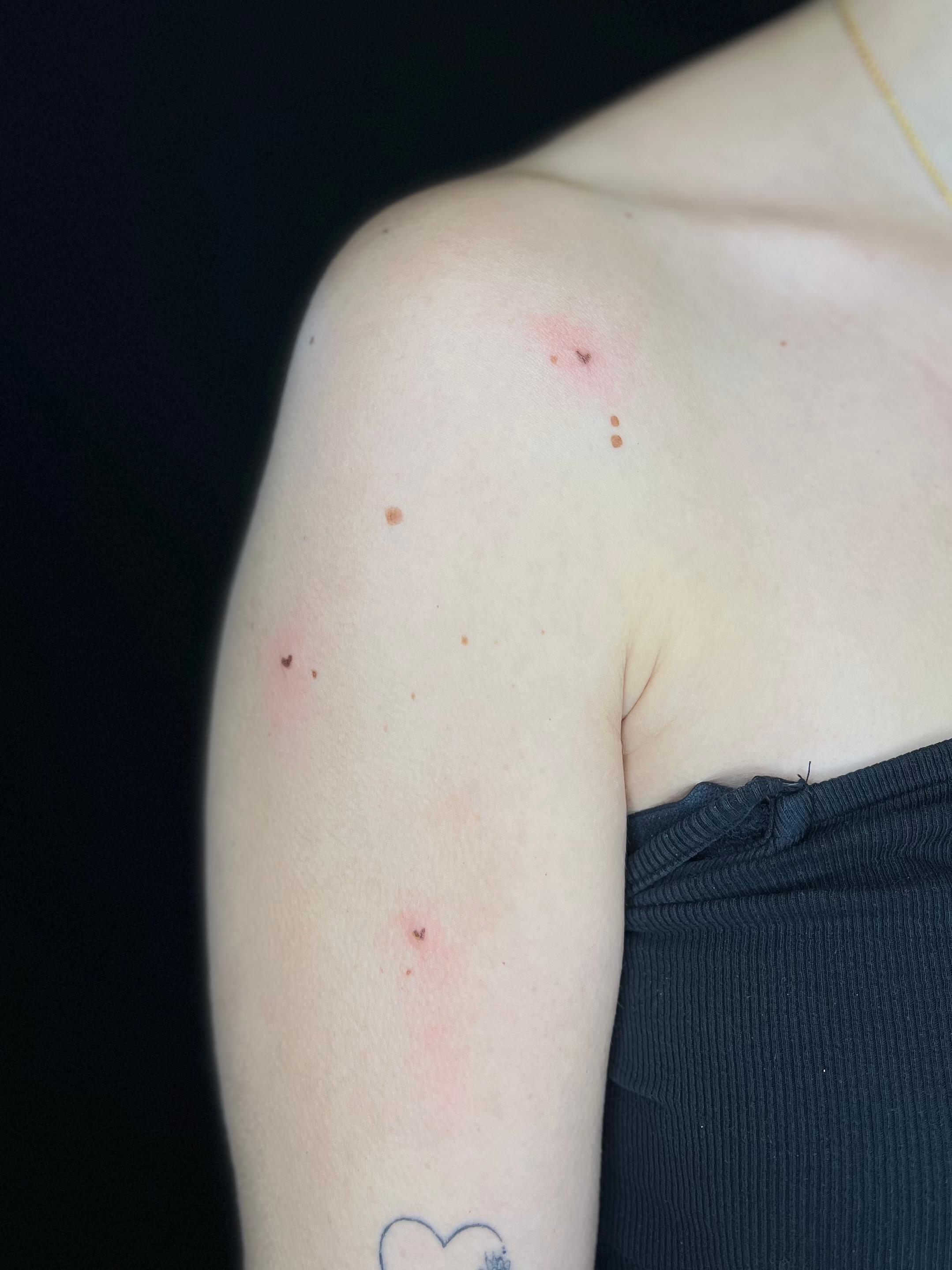 Freckle hearts, direct na de behandeling