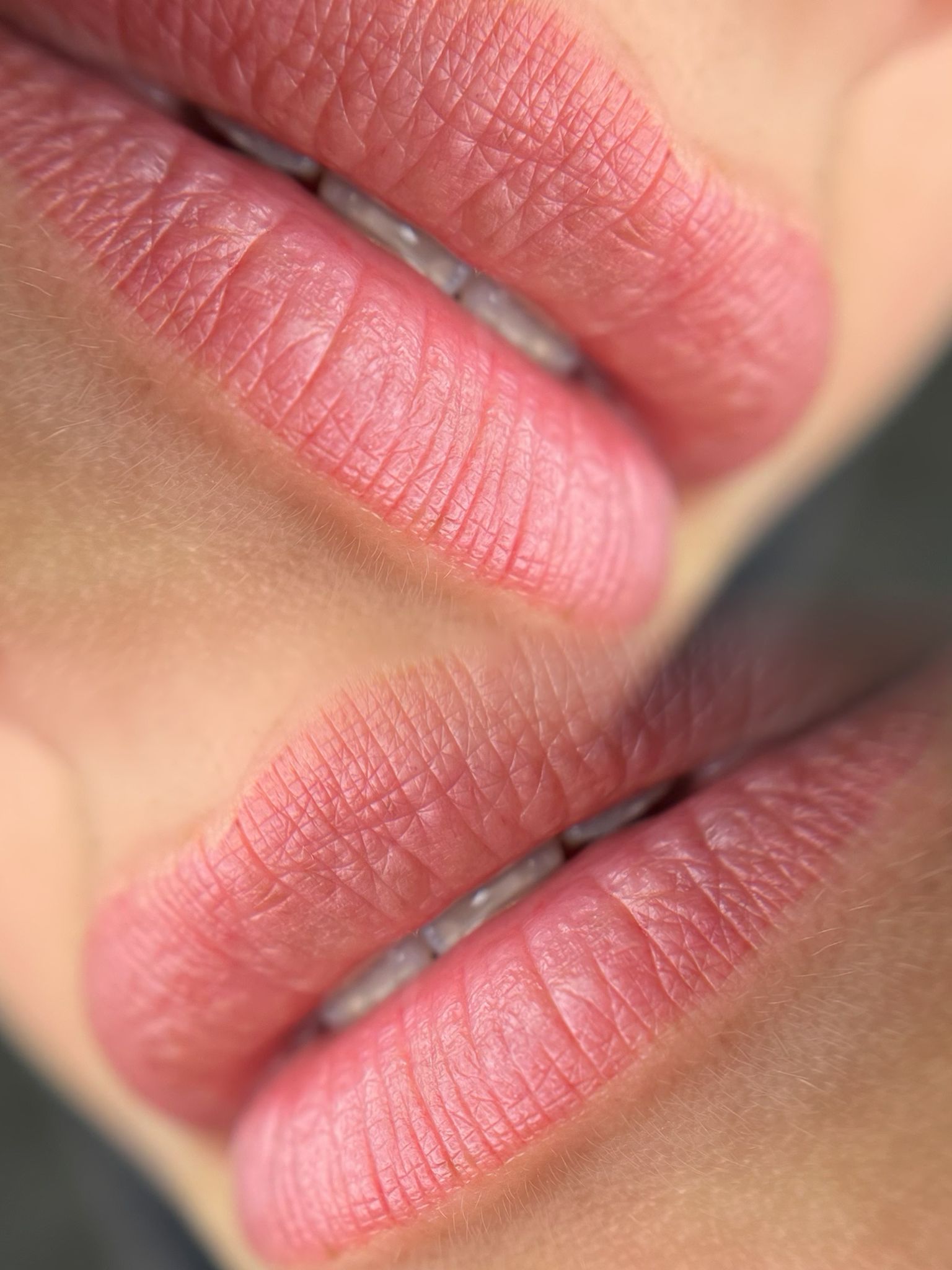 Lippigmentatie genezen