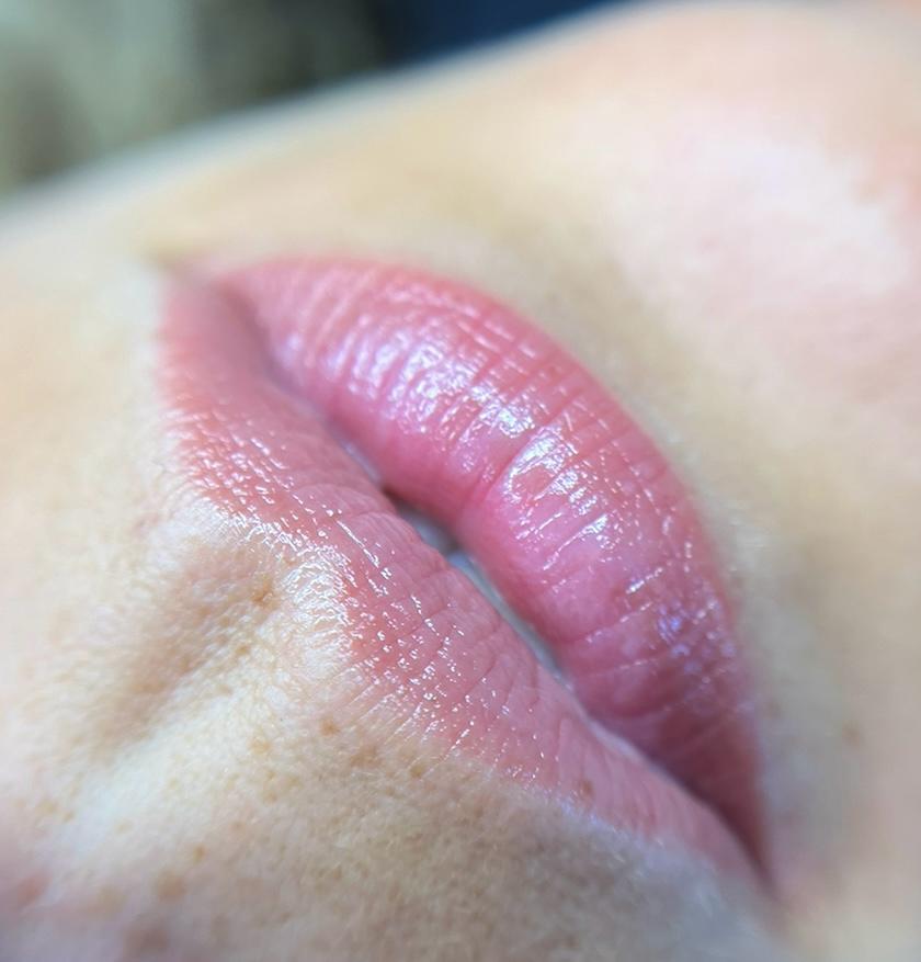 Lippigmentatie genezen