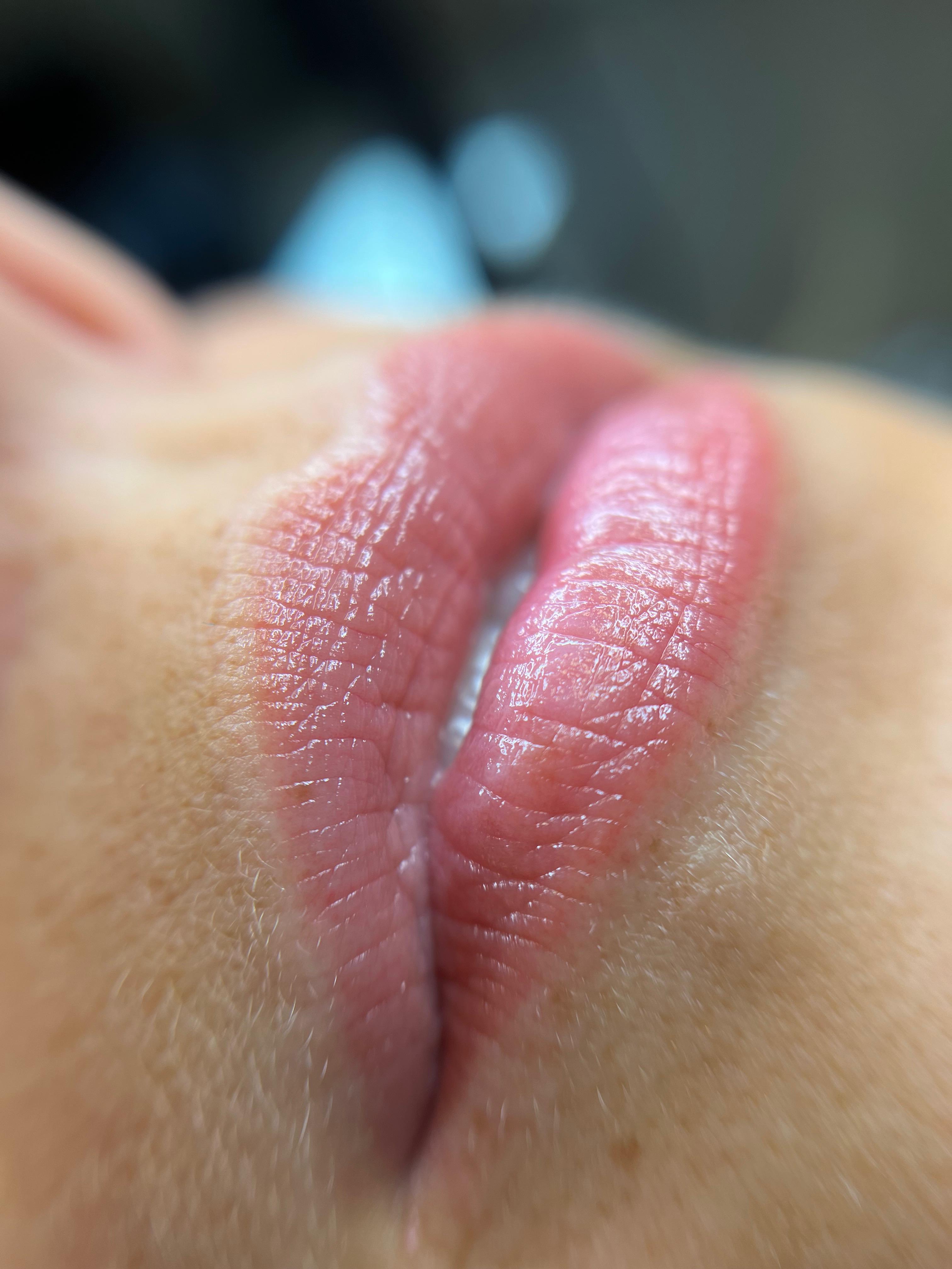 Lippigmentatie genezen