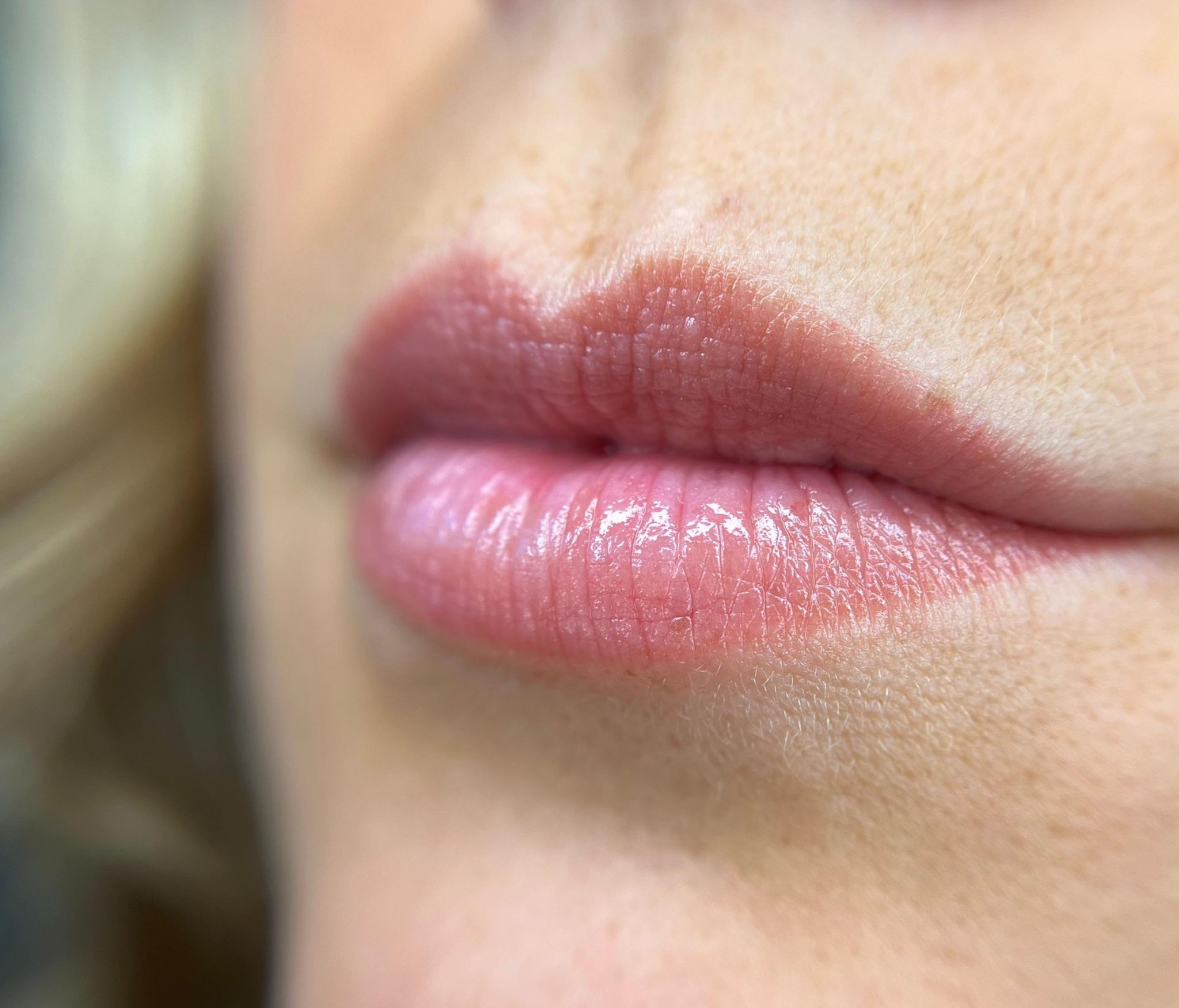 Lippigmentatie genezen