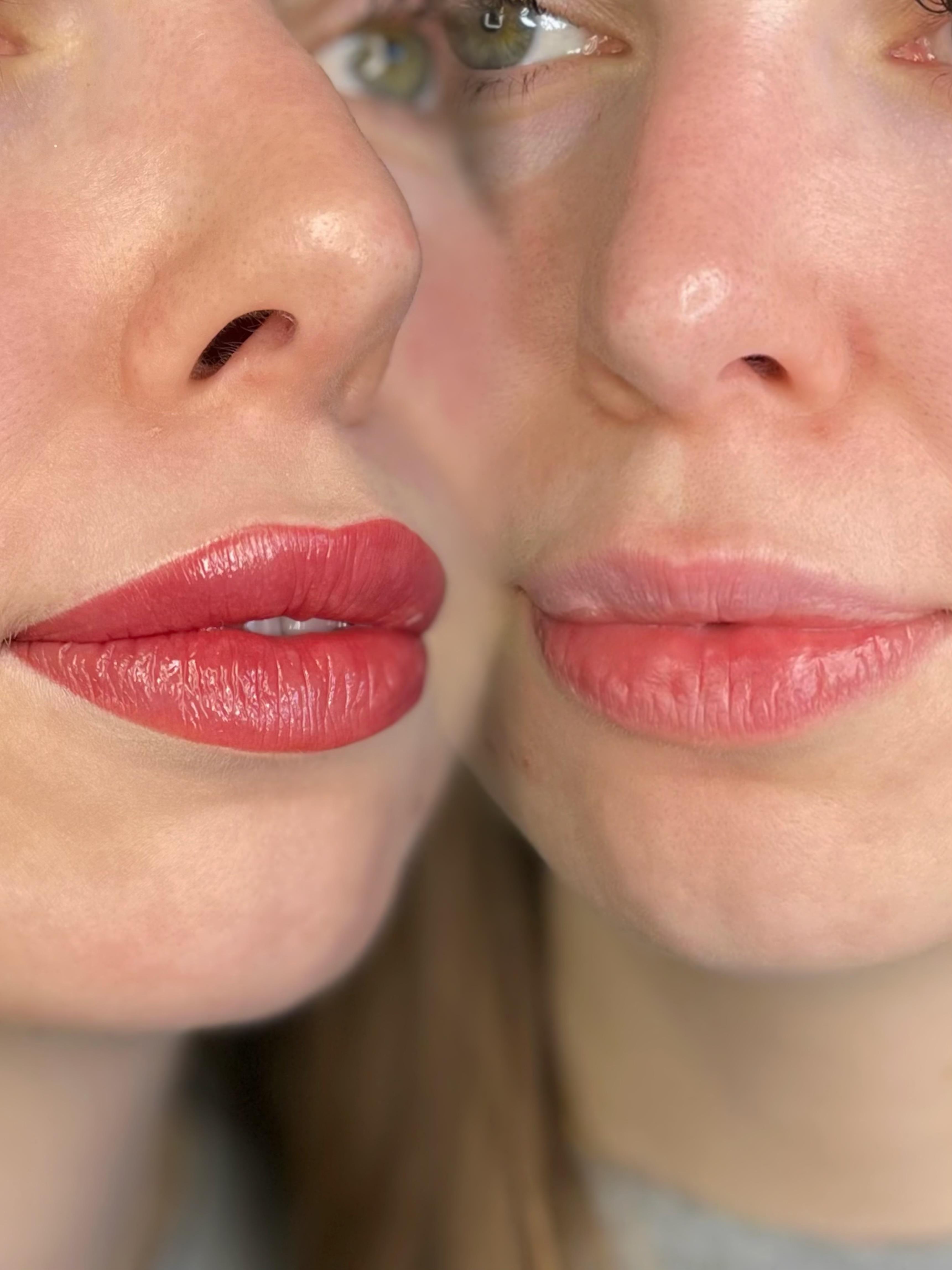 Lippigmentatie, voor & direct na de behandeling