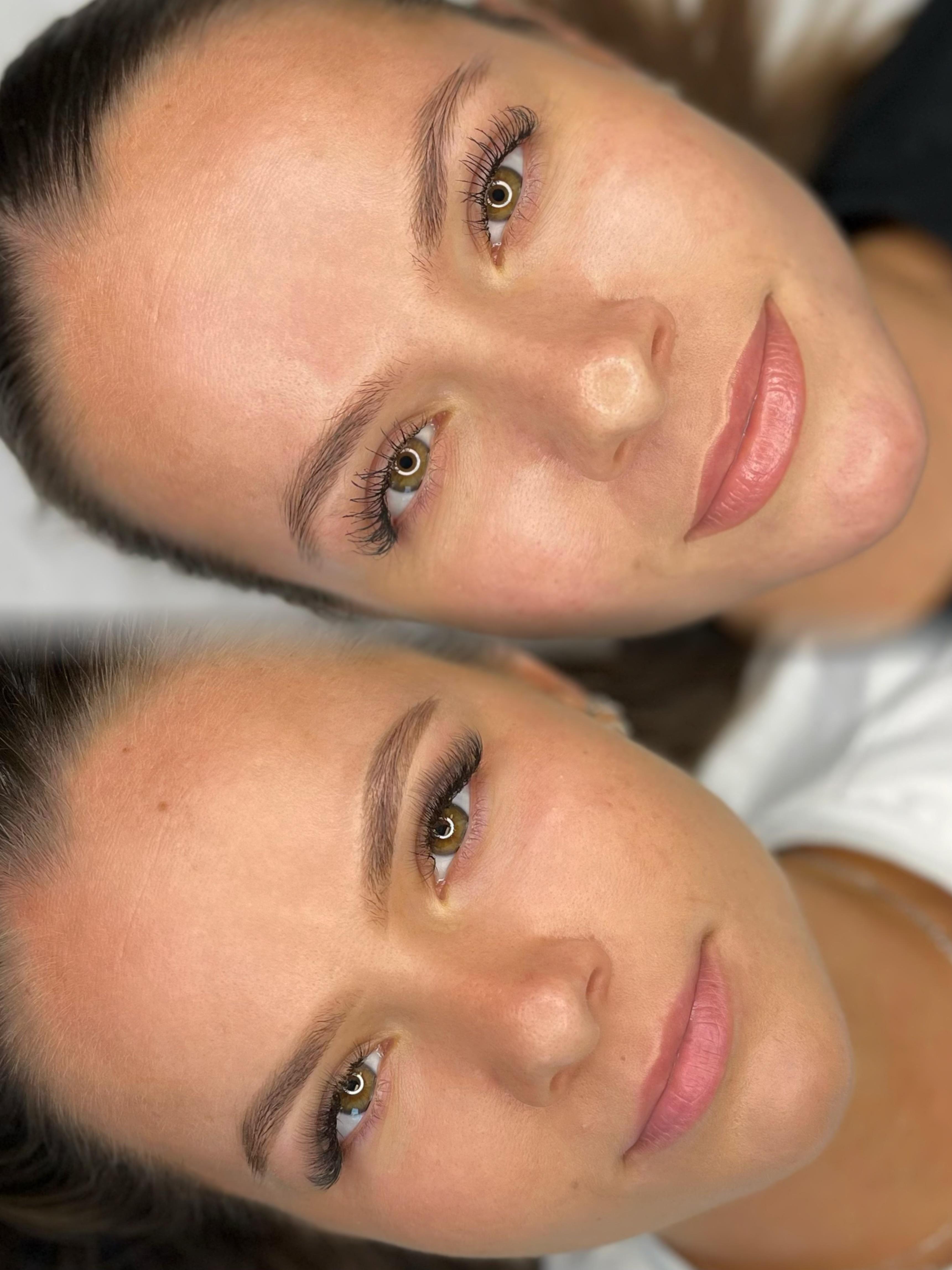 Lippigmentatie, voor & genezen