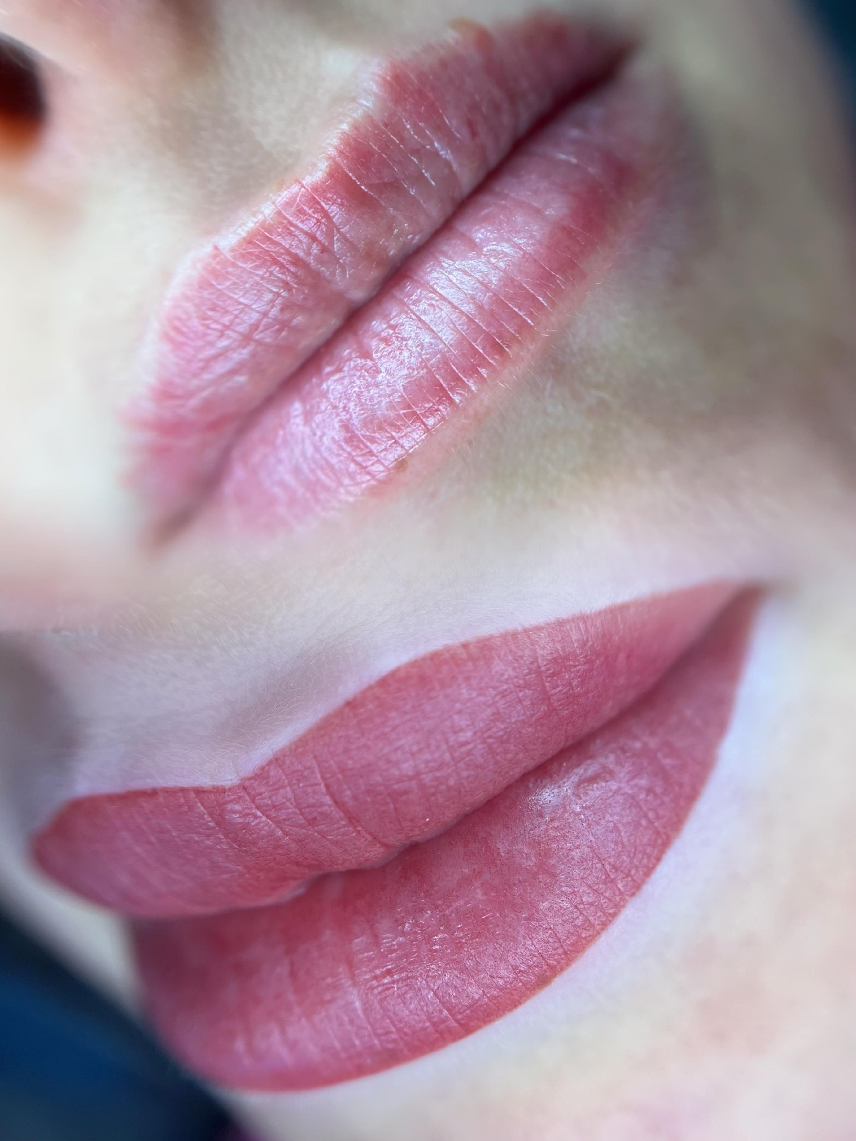 Lippigmentatie, voor & direct na de behandeling