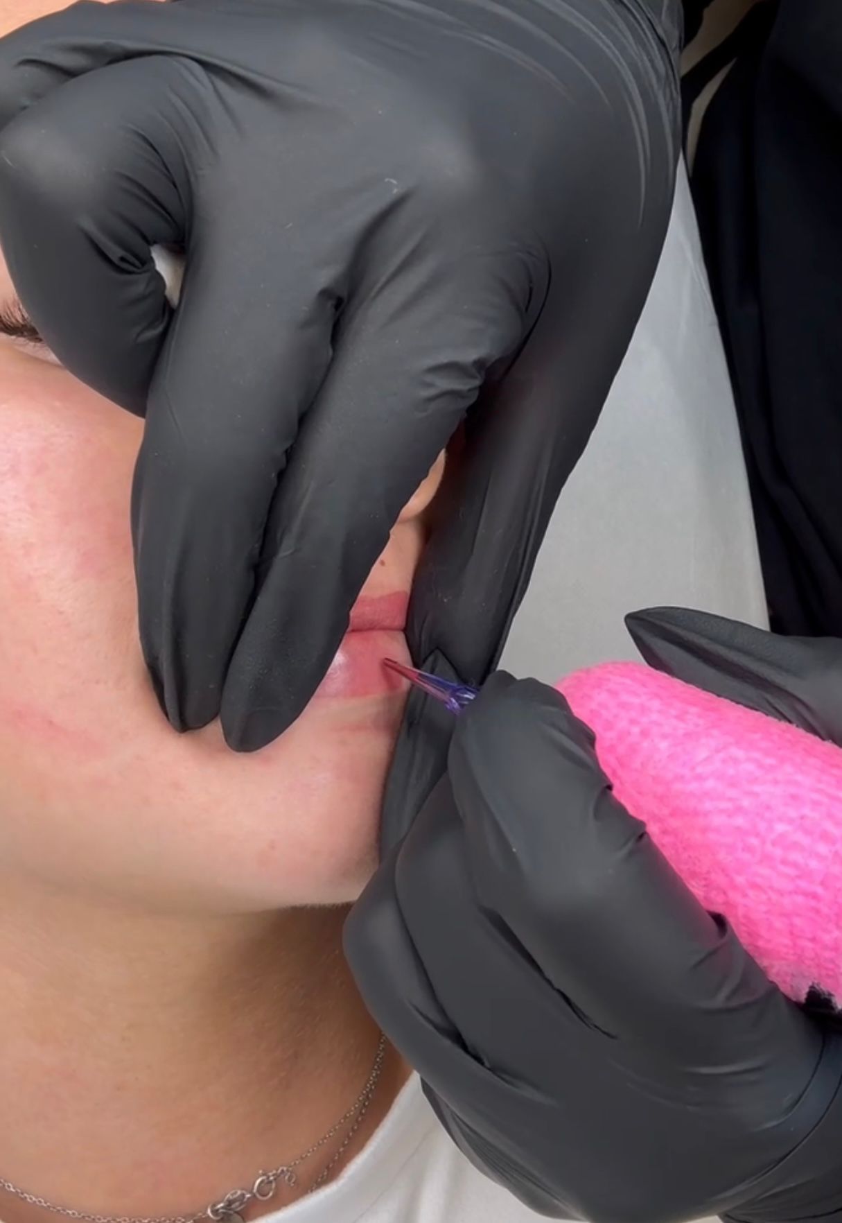 Lippigmentatie behandeling