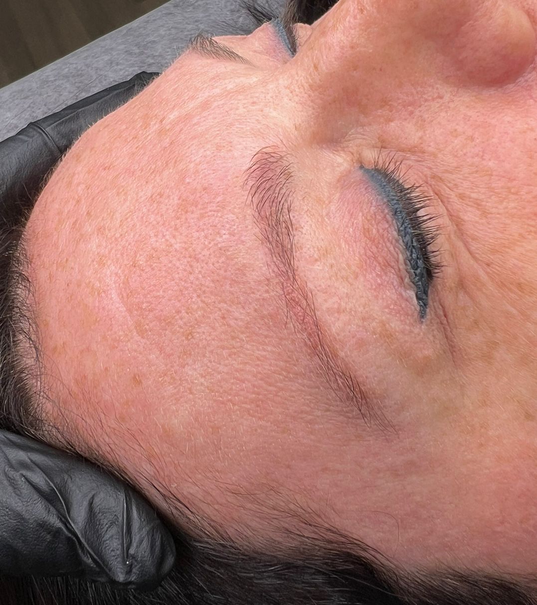 Non Laser Removal voorbereiding